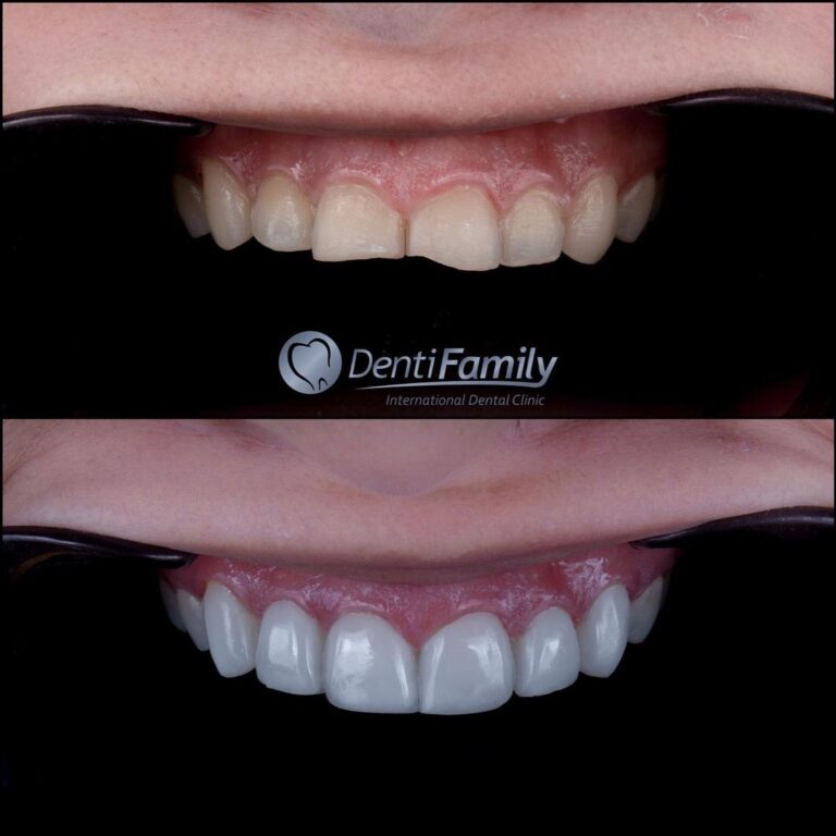 Smile+Design++#veneers+#porcelainveneers+#compositeveneers+#dientesblancos+#dientesperfectos+#diseñodesonrisacolombia+#diseñodesonrisabucaramanga+#carillasdeporcelana+#carillasderesina